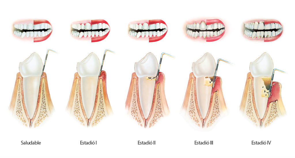 Gingivitis clínica dental Sánchez León clínica dental Sánchez León